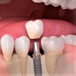 implant dentaire tunis